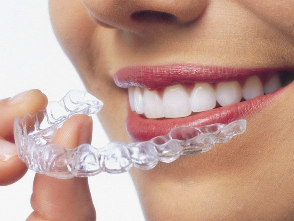 Invisalign Unsichtbare Zahnspange 2