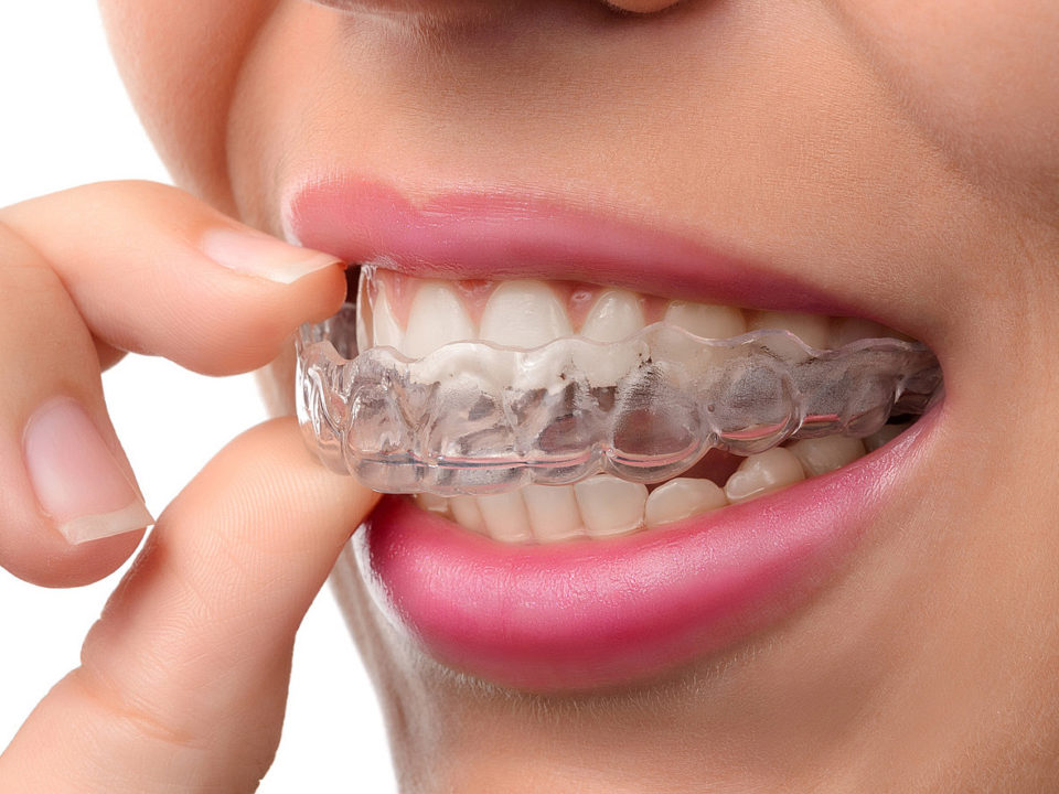 Invisalign-unsichtbare-zahnspange-3